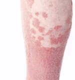 Psoriasis.jpg