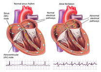 atrial-fibrillation.jpg